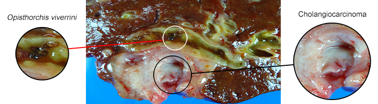CCA liver resection with live liver fluke present.